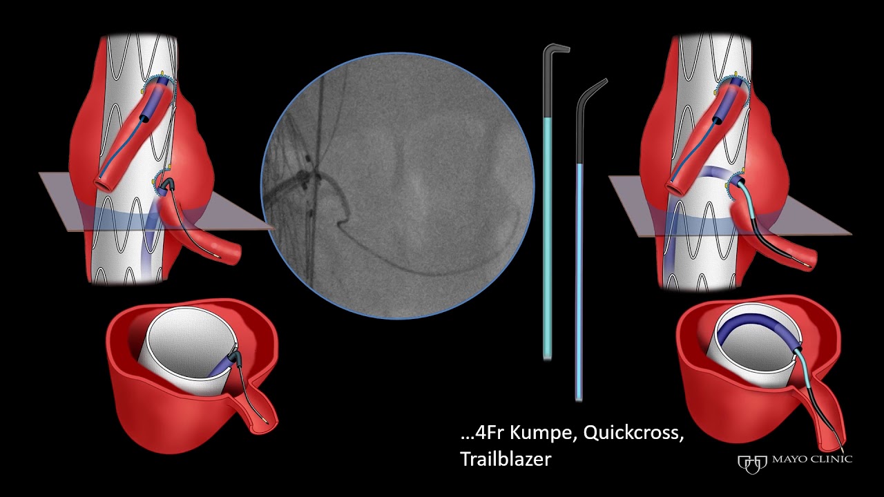 How To Rescue A F/EVAR Procedure When the Fenestrations Are Poorly Aligned With Branch Orifices