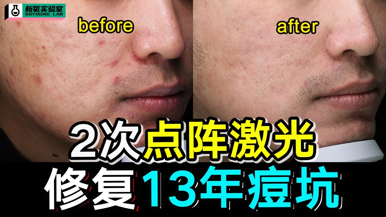 毁容式治痘坑！真人实测点阵激光3个月，真的平了！
