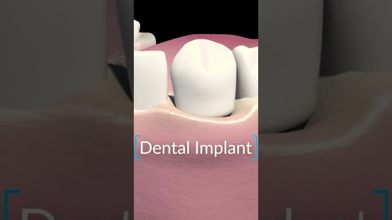 IMPLANT Vs. BRIDGE - which is better, for whom and why? #dentistry #shorts