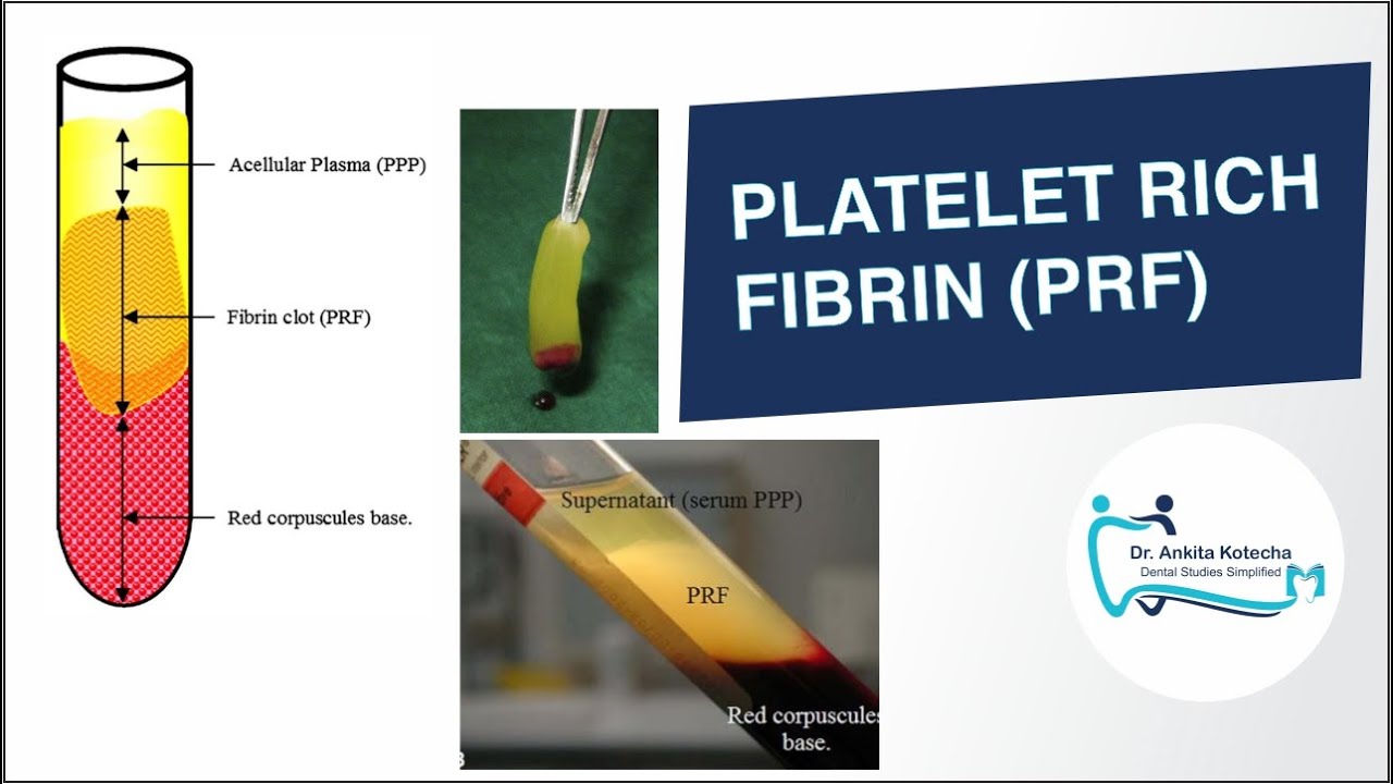 PLATELET RICH FIBRIN (PRF) IN PERIODONTICS/ BIOLOGIC PROPERTIES/ PREPARATION/ PRF MEMBRANE/ PRF PLUG