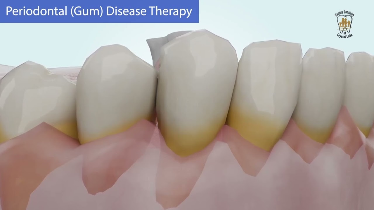 Peridontal Gum Disease Therapy