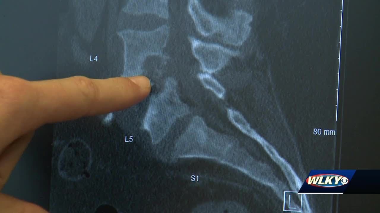 STATE OF ADDICTION: Heroin linked to drastic increase in spine infections