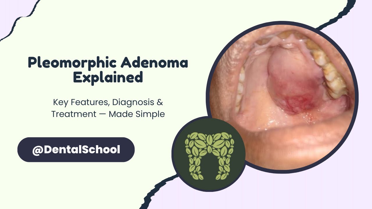 Pleomorphic Adenoma | Everything You Need to Know in Minutes