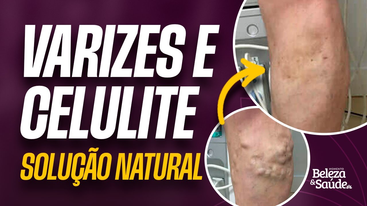 Varizes e Celulite tratadas com Óleos Essenciais