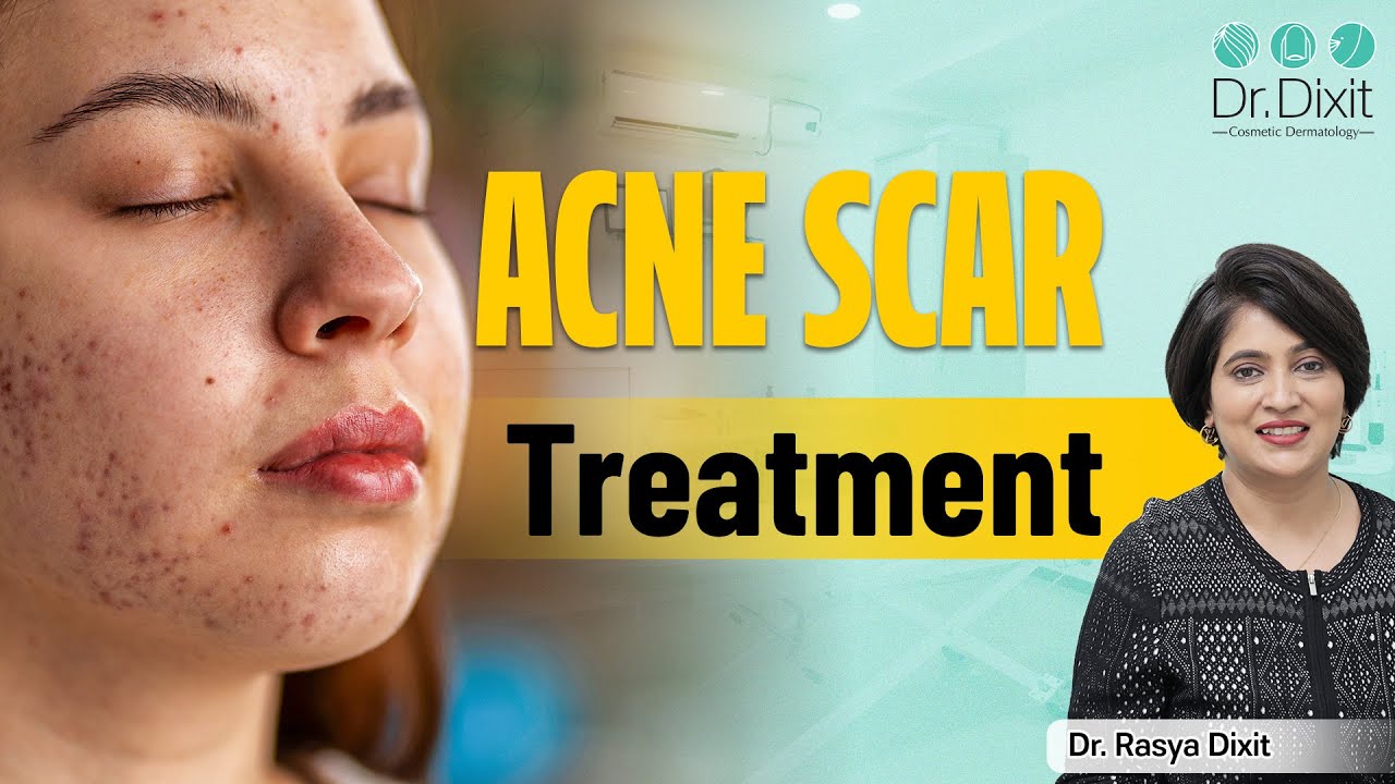 Treatment for Acne Scars on Face | Acne Scar Treatment in Bangalore | Dr. Rasya Dixit