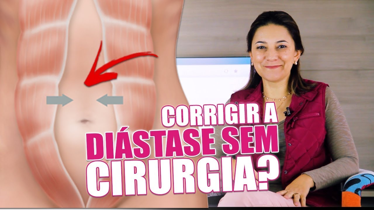 Como corrigir a diástase sem cirurgia?