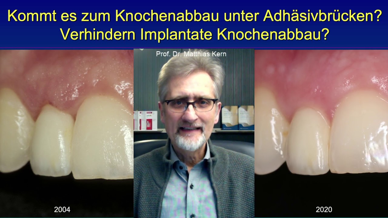 Kommt es zum Knochenabbau unter Adh&auml;sivbr&uuml;cken?