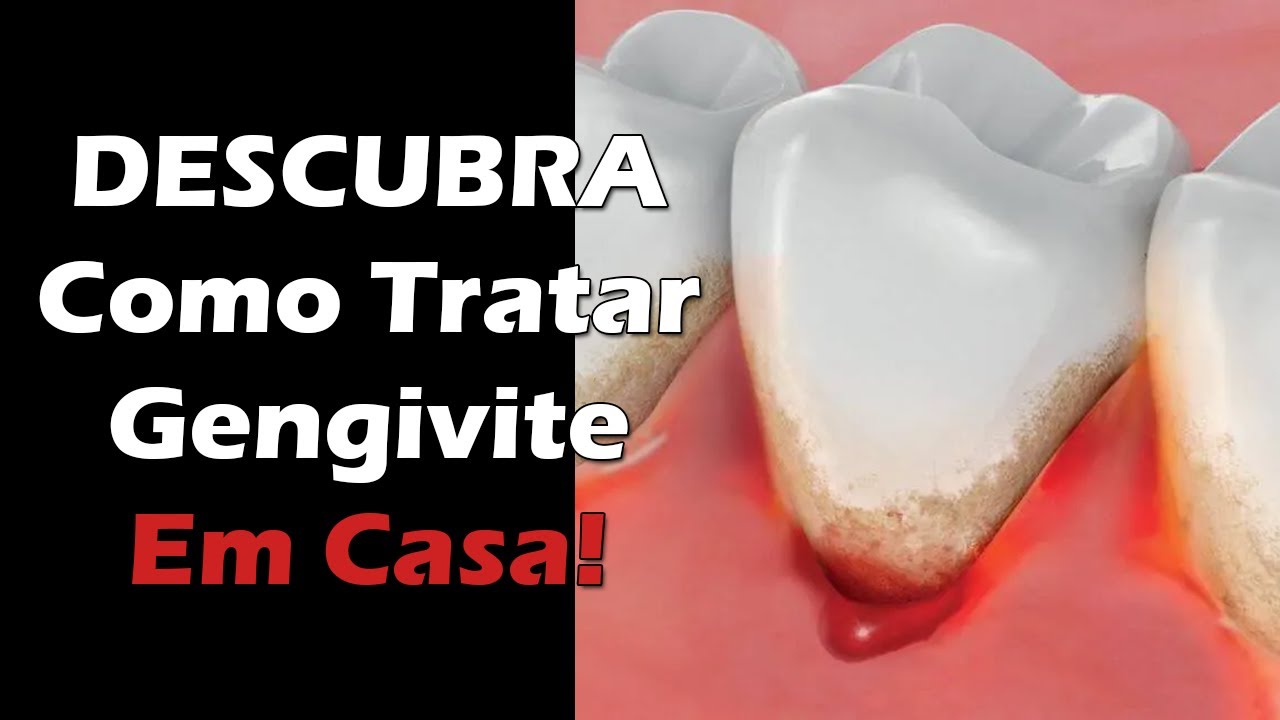Descubra Como Tratar Gengivite em Casa - Gengiva Inflamada, Inchada e Sangrando - Tratamento Caseiro