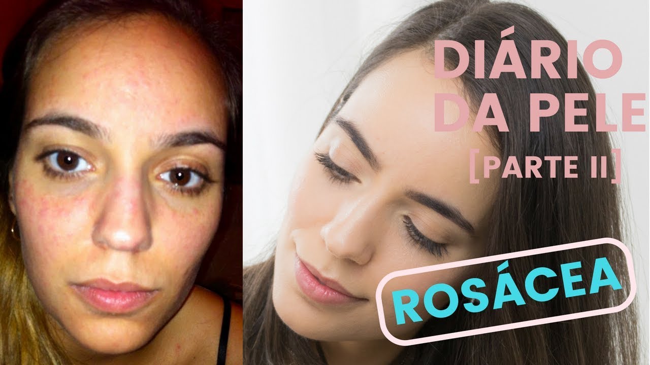 Rosácea - Meu tratamento com Azelan! [Diário da Pele - Parte II] | Iruama
