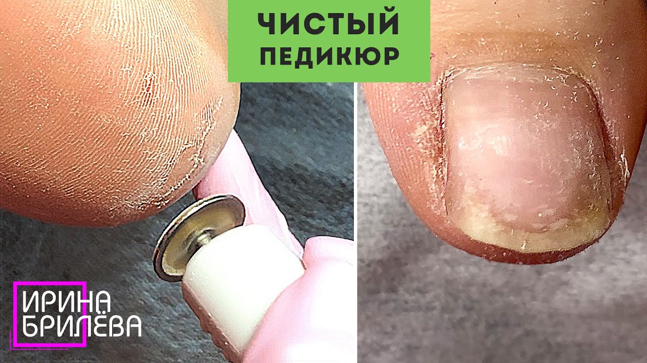 Чистый ПЕДИКЮР 🌸 Обработка ТРЕЩИН дисками 🌸 Ирина Брилёва