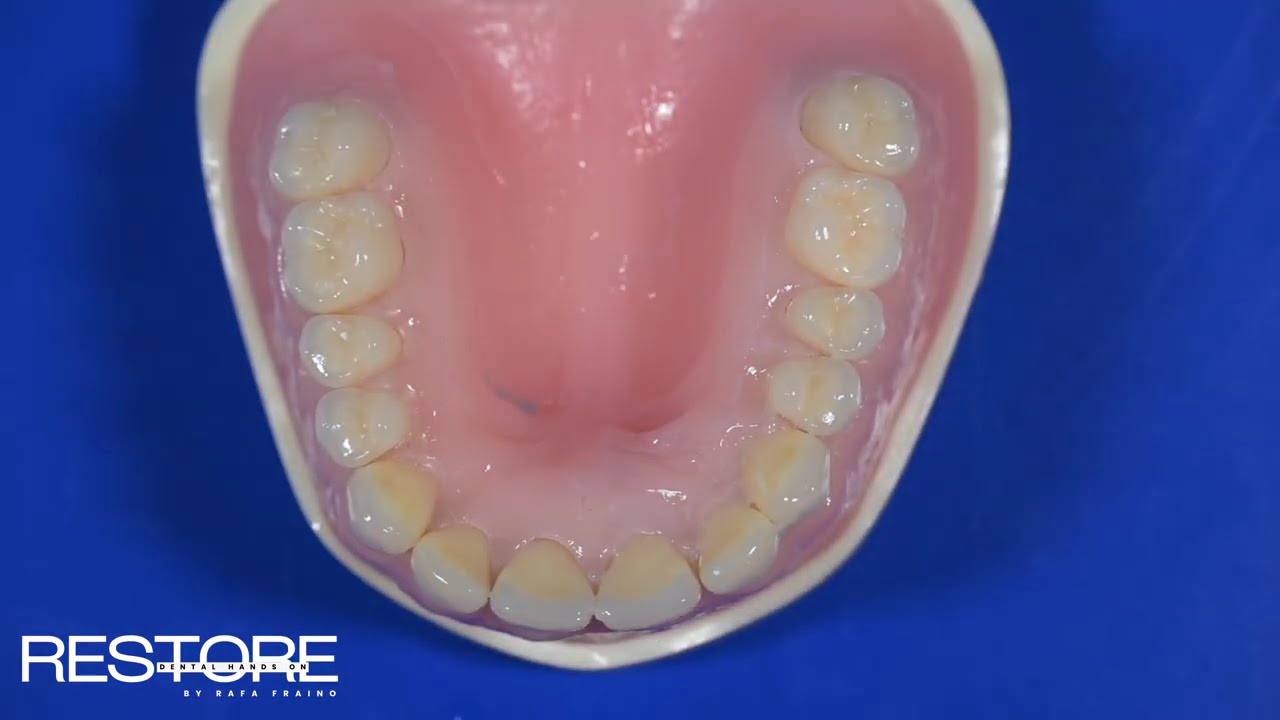 Guía de silicona para restaurar fractura dental anterior Clase IV