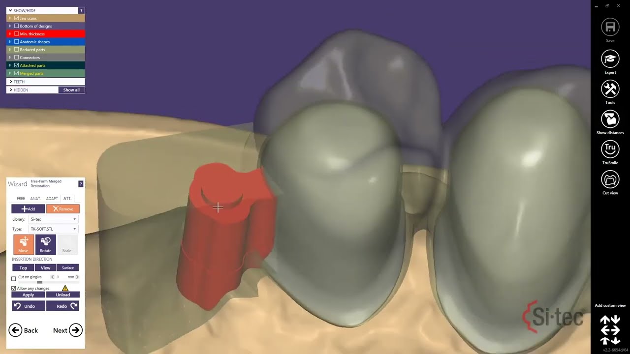Si-tec® TK-Soft Anwendung in exocad [deutsch]