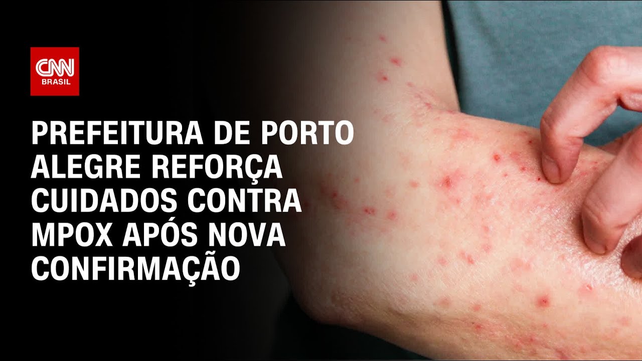Primeiro caso de Mpox é confirmado em Porto Alegre em 2026 | CNN NOVO DIA
