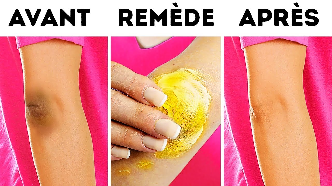 10 Astuces naturelles pour se d&eacute;barrasser des taches sombres sur les coudes et les genoux