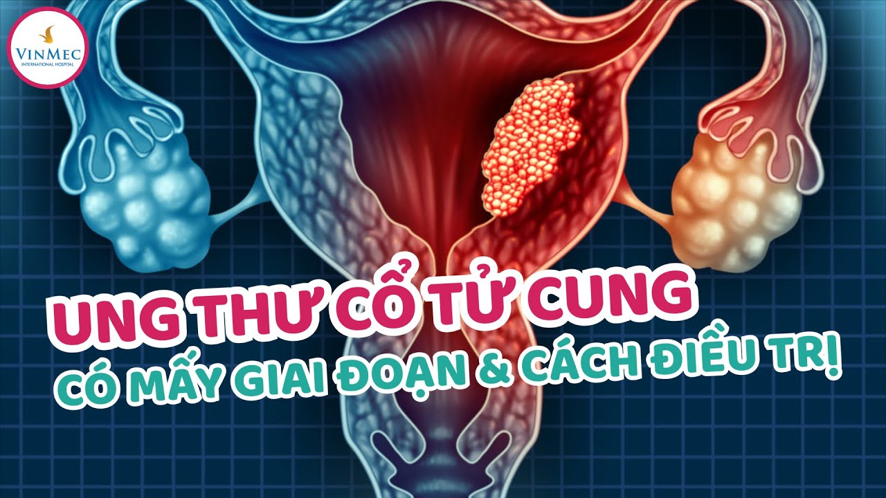 Ung thư cổ tử cung có mấy giai đoạn và cách điều trị | BS Nguyễn Gia Hoàng Anh, BV Vinmec Phú Quốc