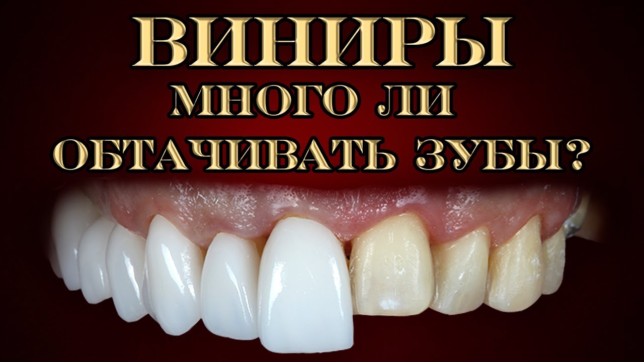 Много ли обтачивают зубы для виниров? 8 серия.