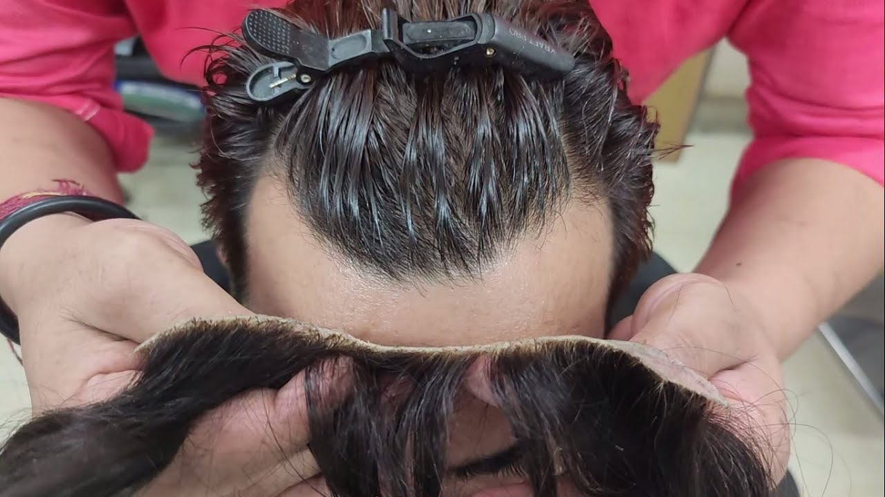 Frontline Hair Patch for Men in Delhi | Amazing Hair Replacement Process 📱 9899746489