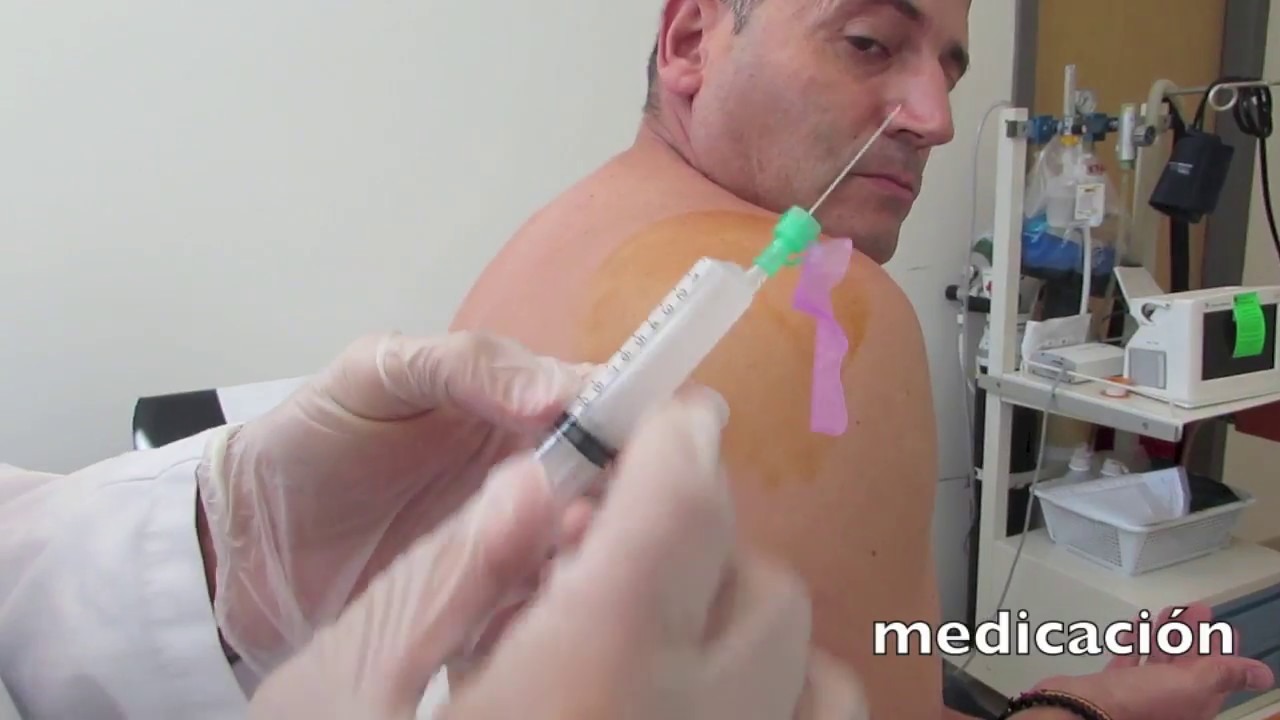▸ Tratamiento Hombro Doloroso ¿Cómo es una Infiltración Hombro Doloroso Sindrome Subacromial?