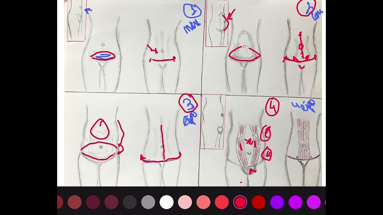 Karın germe ameliyatı #karıngerme #tummytucksurgery #abdominoplasty