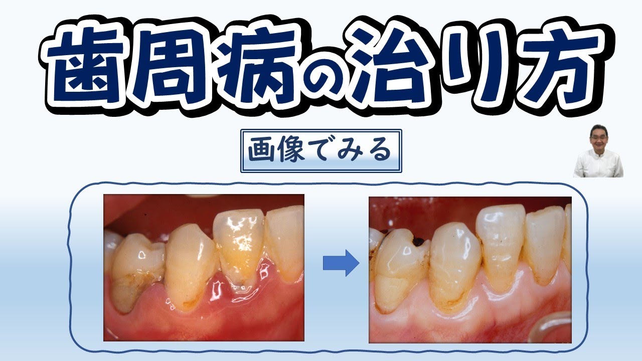 画像でみる、歯周病の治り方・歯肉炎は炎症の消退する過程、歯周炎は組織破壊の再生過程