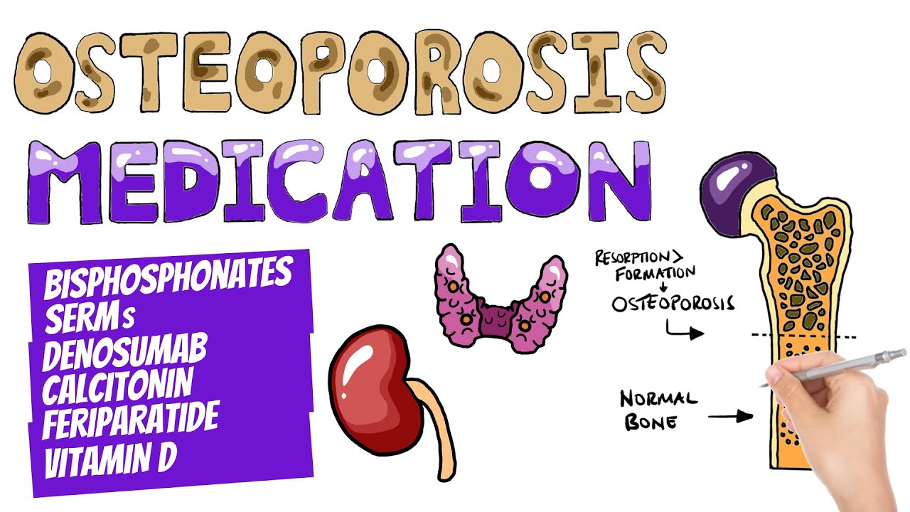 Osteoporosis Medications and Management | Which Drugs Are Used To Treat Osteoporosis?