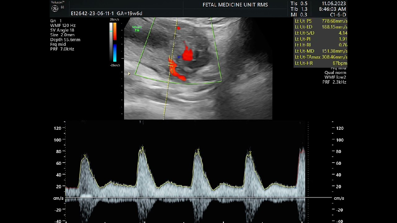uterine artery Doppler in pregnancy