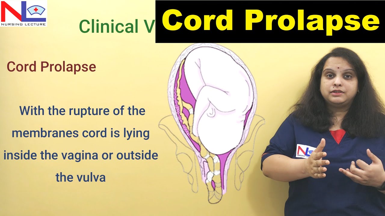 Cord Prolapse | Definition, Risk factors, Diagnosis | Nursing Lecture