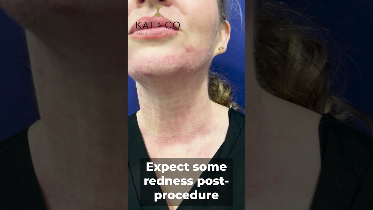 CO2 Laser Non-Surgical Necklift 😍 | Kat & Co