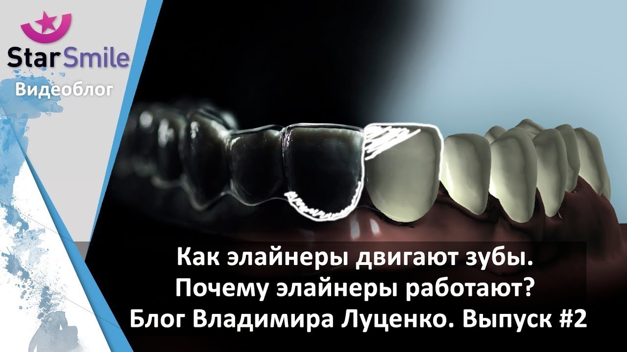 Работают ли элайнеры для выравнивания зубов?