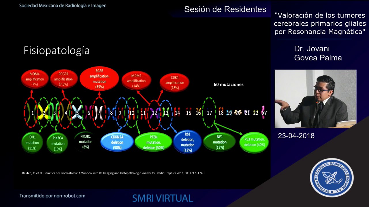 Valoración de tumores primarios gliales por Resonancia Magnética