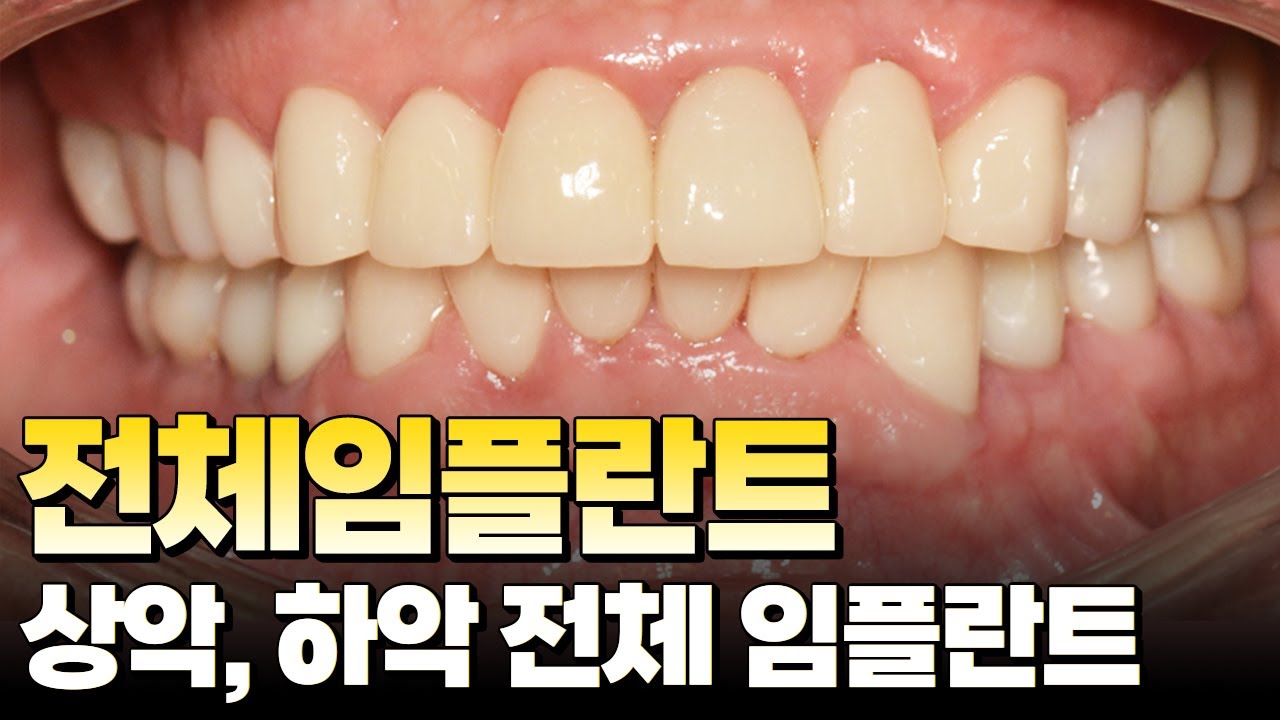 [대전치과, 대전 임플란트 ]전체임플란트(상악+하악 전체 임플란트) #대전임플란트