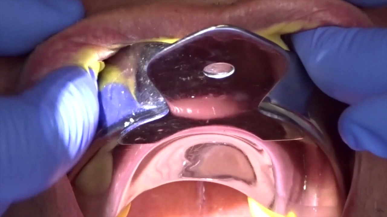 Panasil initial contact and Panasil tray soft