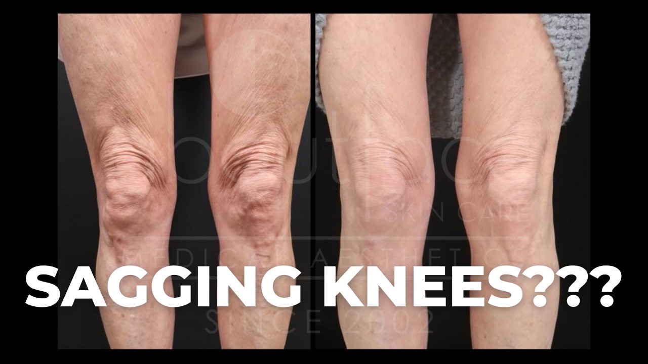 Atlanta’s New Everesse Knee Lift