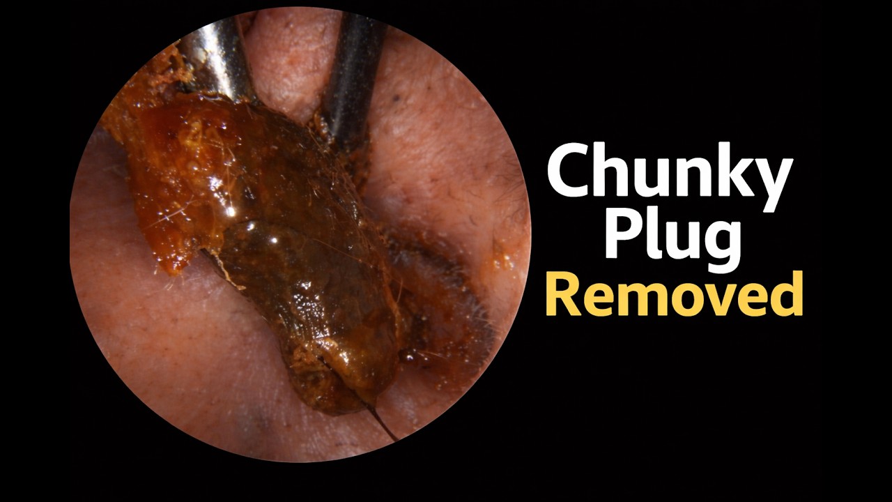 Completely Blocked Ear Canals &ndash; Two Chunky Ear Wax Plugs Removed - EP1234