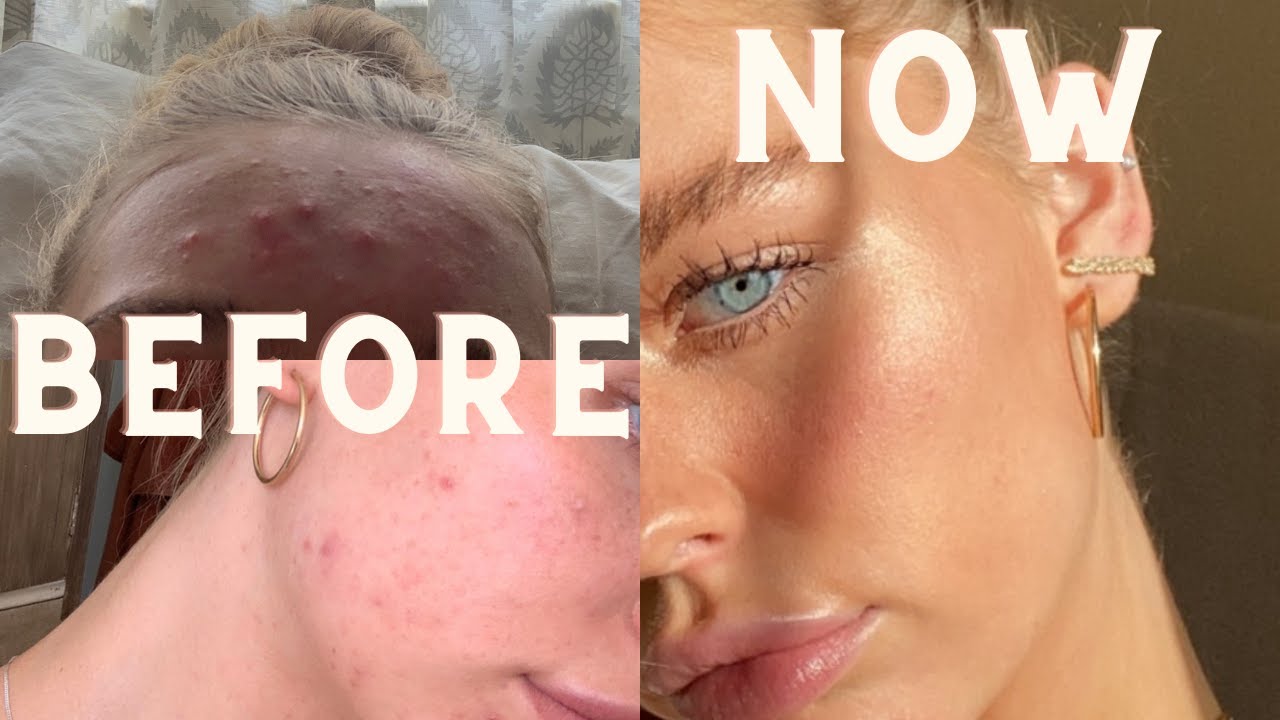 my accutane journey