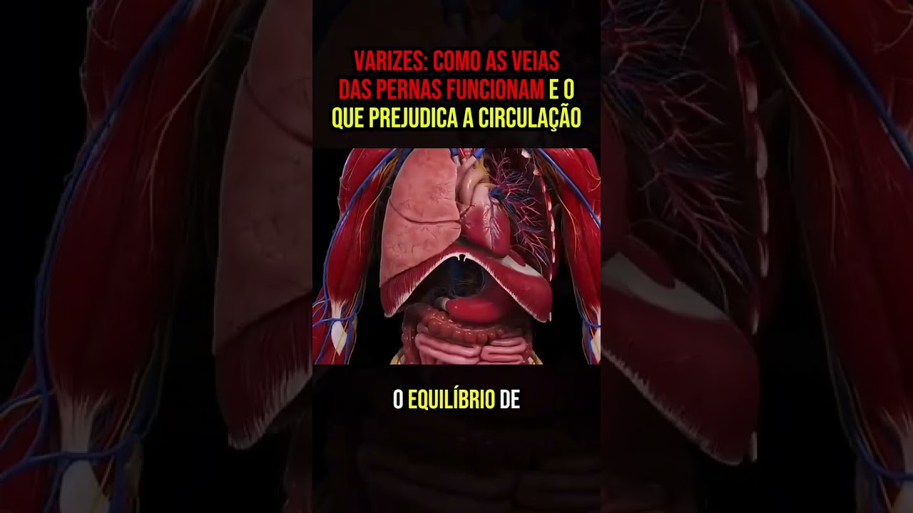 varizes nas pernas  #varizes #veias #circulacao #veins #circulation