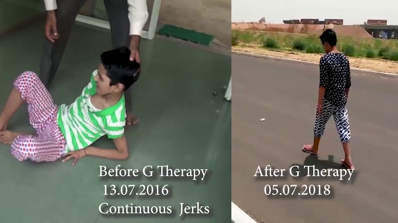 Treatment of SSPE - Neurology Treatment - न्यूरोलॉजी उपचार - 神經內科治療 - న్యూరాలజీ చికిత్స - G Therapy