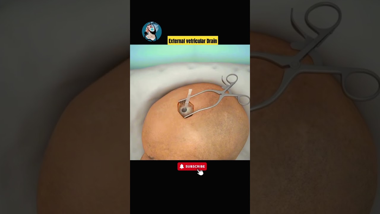 This is How fluid is drain from Skull.