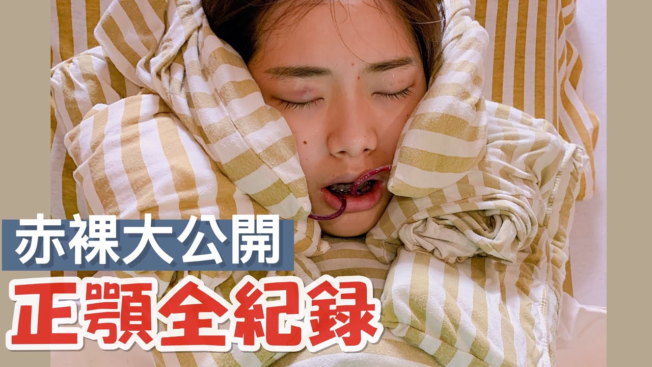 正顎手術 | 正顎住院 實況紀錄公開