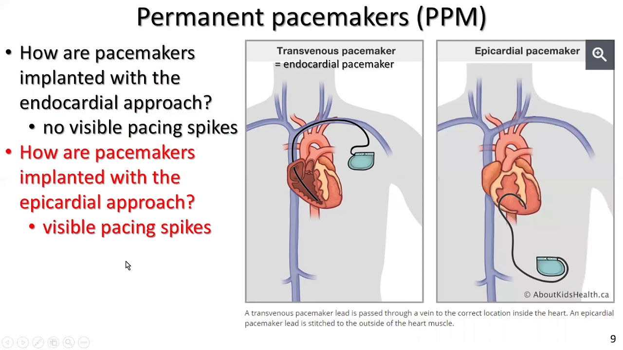 Permanent pacemakers and implantable cardiac defibrillators for exercise professionals: the basics