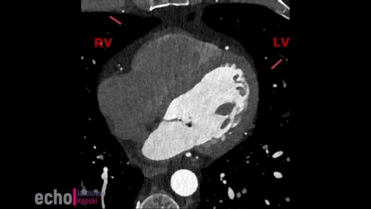 Normal Coronary CT Angiography (CTCA) – Example of a Healthy Coronary Anatomy