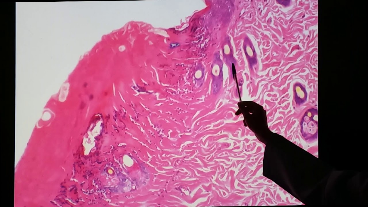 Cicatrização de ferida 1. Fase inflamatória