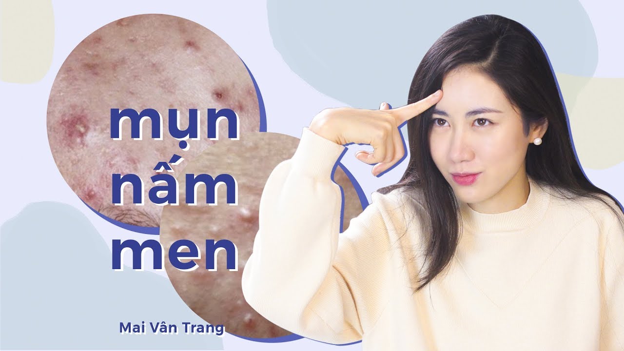 TRÁN LẨN MẨN MỤN VÀ CÁCH THANH LÝ CHÚNG | Mụn Nấm Men | Fungal Acne