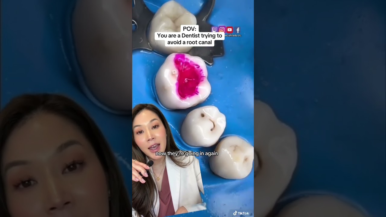 How can dentists see cavities? 👀 ￼ #cavity #cavities #dentist #molar #filling #tooth