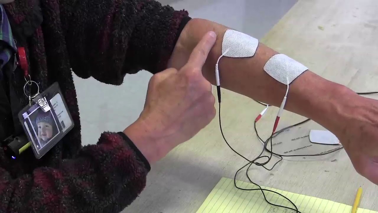 Stroke Rehabilitation: Use of electrical stimulation to help arm and hand recovery