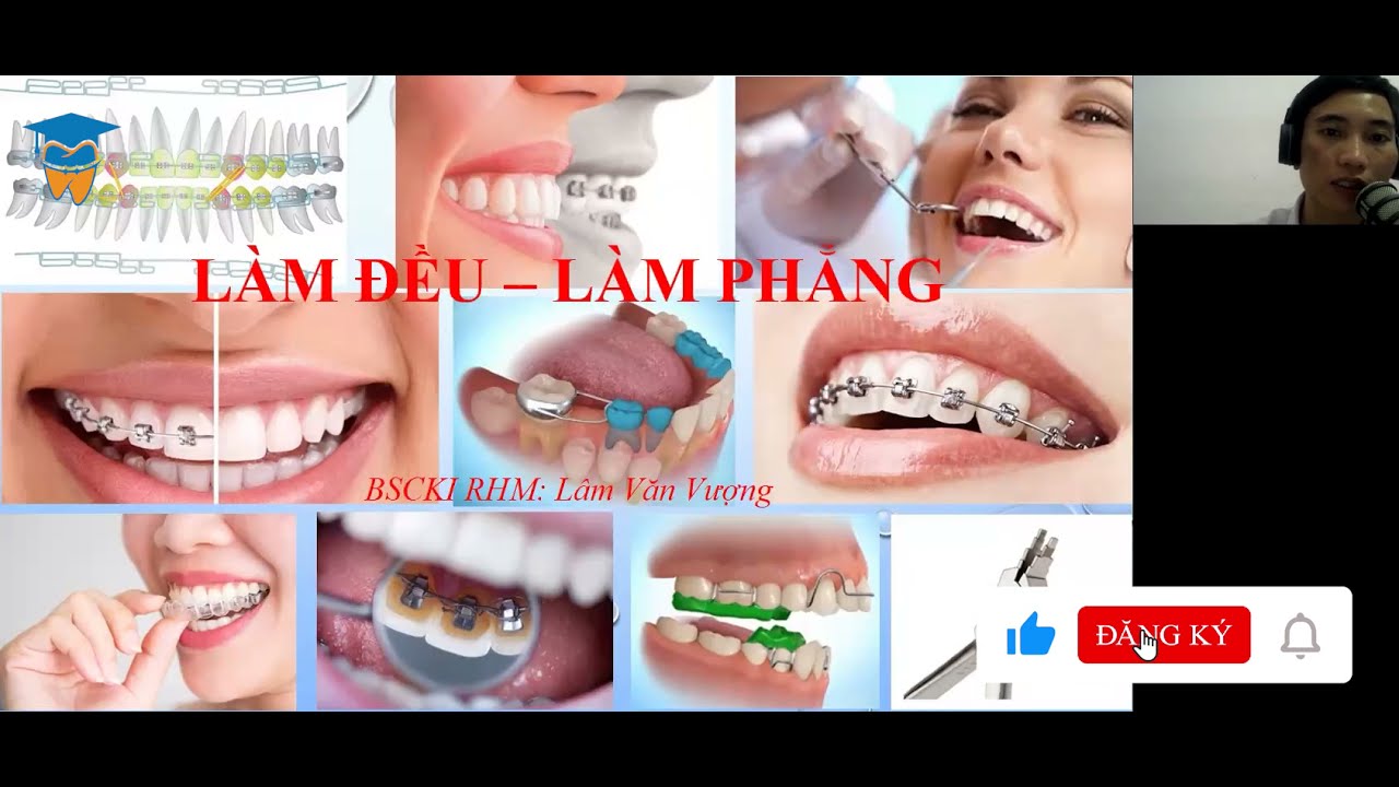 Bài 13: Làm Đều Làm Phẳng Trong Niềng Răng | Học Chỉnh Nha