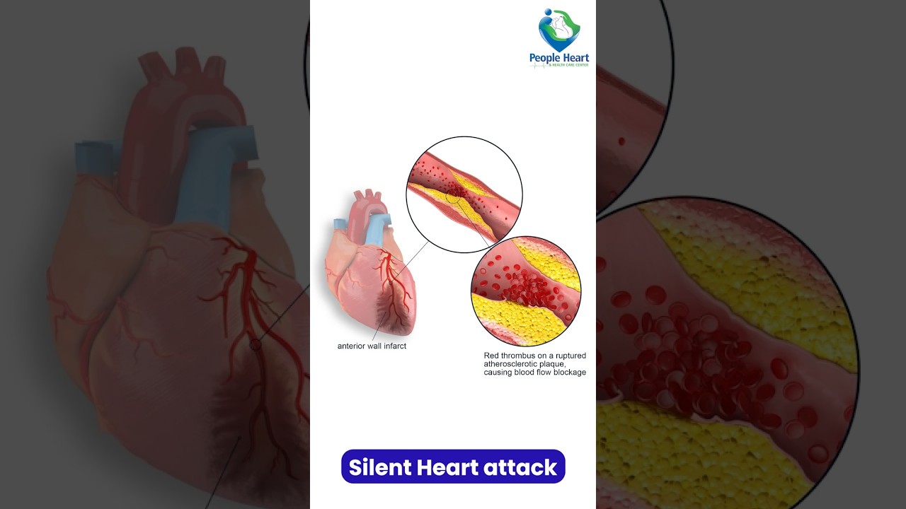Silent Heart Attack by Dr. Chetan Sharma #silentheartattack #doctor