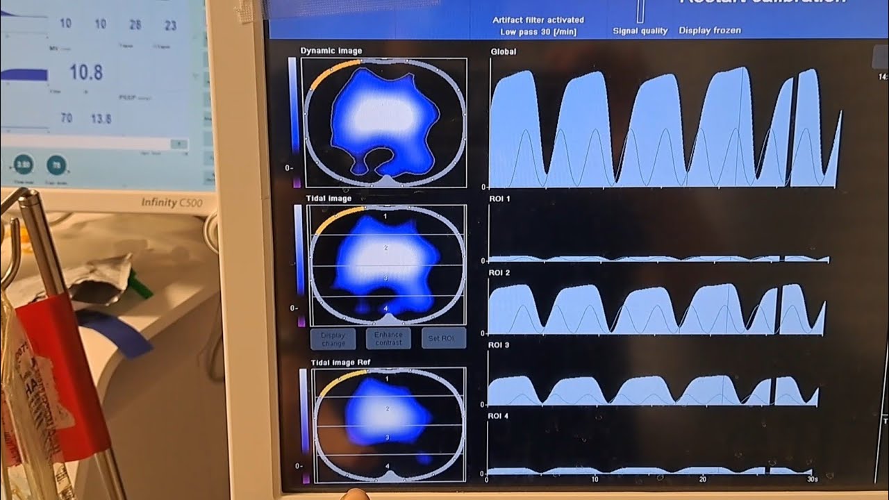 PULMOVISTA 500 GUIDED LUNG RECRUITMENT USING APRV