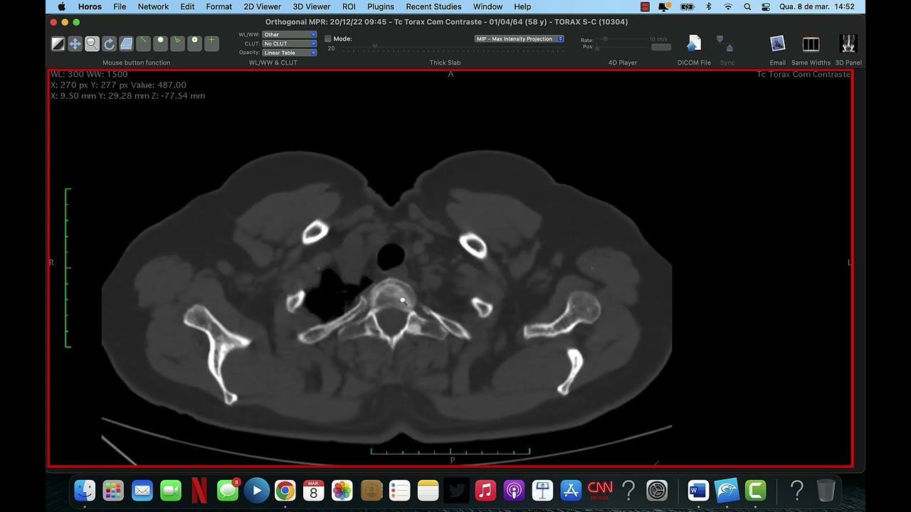 ANATOMIA NA TOMOGRAFIA DE TÓRAX