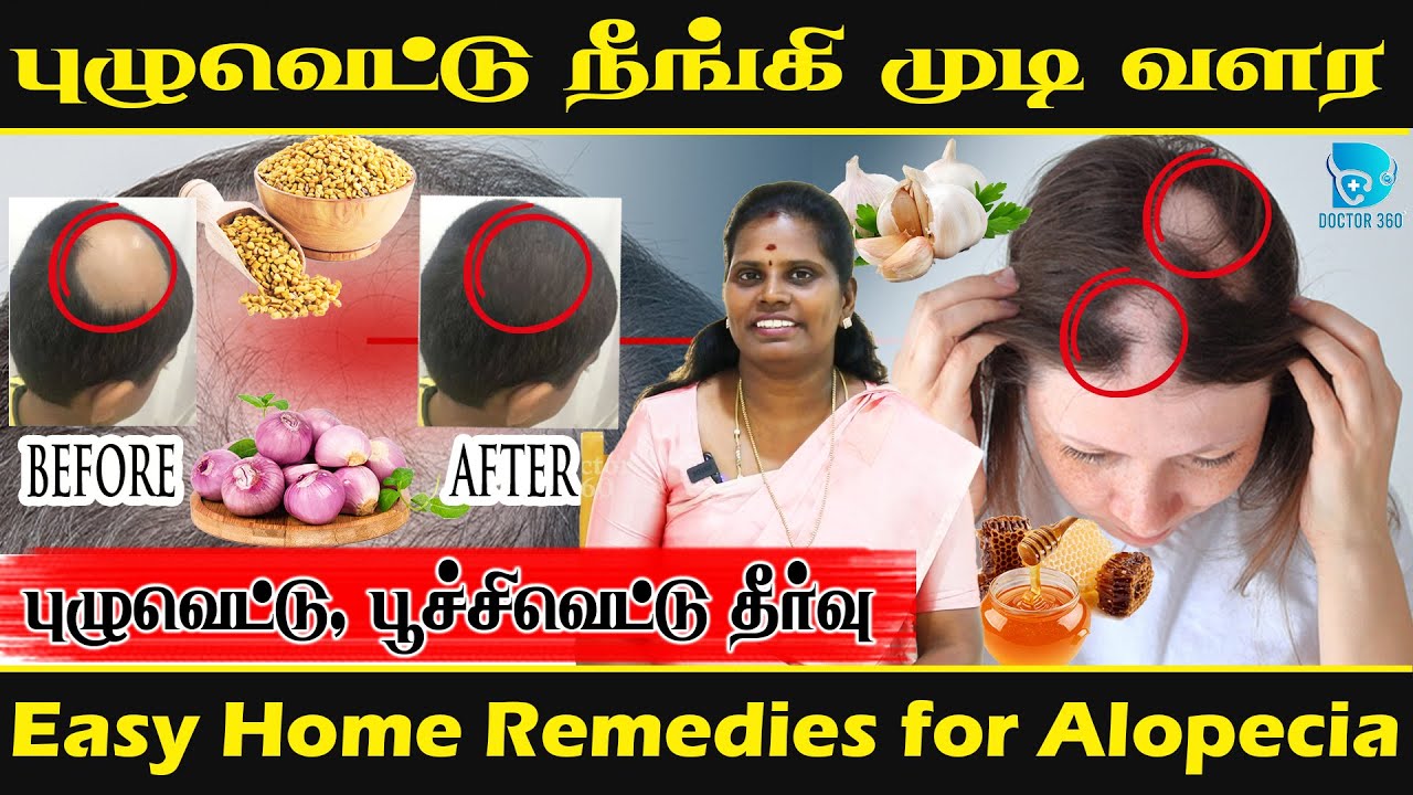 புழு வெட்டு நோயை வீட்டில் இருக்கும் பொருட்களில் குணப்படுத்த முடியுமா! #hairloss #doctor360 #alopecia